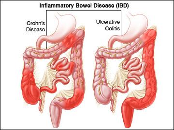 inflammation of_the_intestine